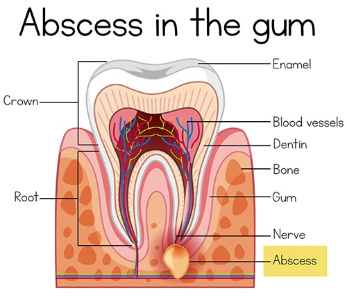 Some abcesses can be very painful and cause you to book an emergency appointment. But some do not exude ant pain until they become serious. To catch an abcess early, or tooth decay and other potential problems we recommend a twice yearly dental checkup.