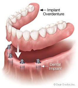 If you need four or more teeth replaced with dental implants this illustration shows how we can insert many teeth on an all on four plate. That means you only need 4 implants for a whole row of teeth.
