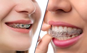 The most conservative and minimally invasive way to close a small gap is orthodontic treatment, either using conventional fixed braces, or invisible braces such as the Invisalign system.