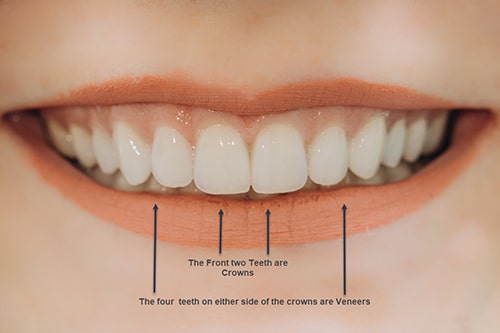 If the gap between your two front teeth is too wide to use veneers then a combination of caps on the front teeth and veneers on the rest is a great solution as this image shows.
