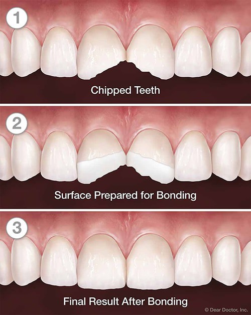 An illustration to show how tooth bonding looks. Bonding is the least invasive solution to closing a gap. However, the drawback with bonding is that it does not last very long and will eventually need to be redone.