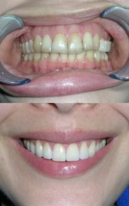 This before and after photo shows the huge difference dental implants can make to your smile but even better than that, they are strong and secure so you can eat normally again. Do you remember when you used to bite into an apple instead of cutting ity into slices?