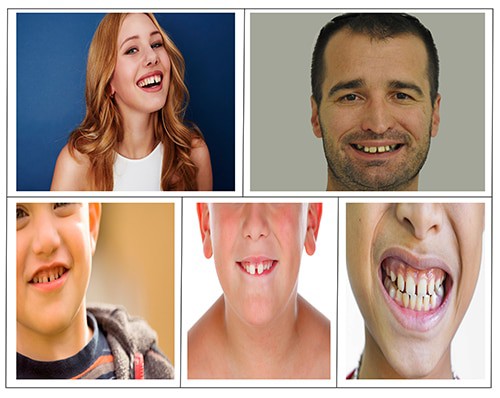 3 children, one young lady and one young man all with gap teeth. While gap teeth can look cute when you are a kid it is prbably best to have those gaps fixed while you are young and not as self conscious of wearing braces as a teenager mighht be.