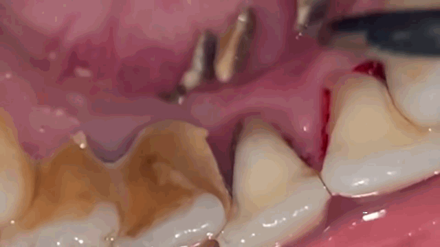 When people don't have a regular dental checkup they will usually experience a build up of tartar around the teeth. This is not only uncomfortable and unsightly but dangerous as it is the cause of many dental diseases including gum disease. Tartar can only be removed by a dentist with the right tools, it is not possible to remove it by brushing or flossing alone.