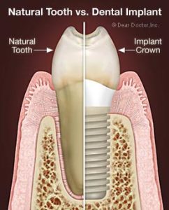Dental implants are titanium screws that are implanted into your jawbone beneath your gums that replace the original roots of the missing tooth. 