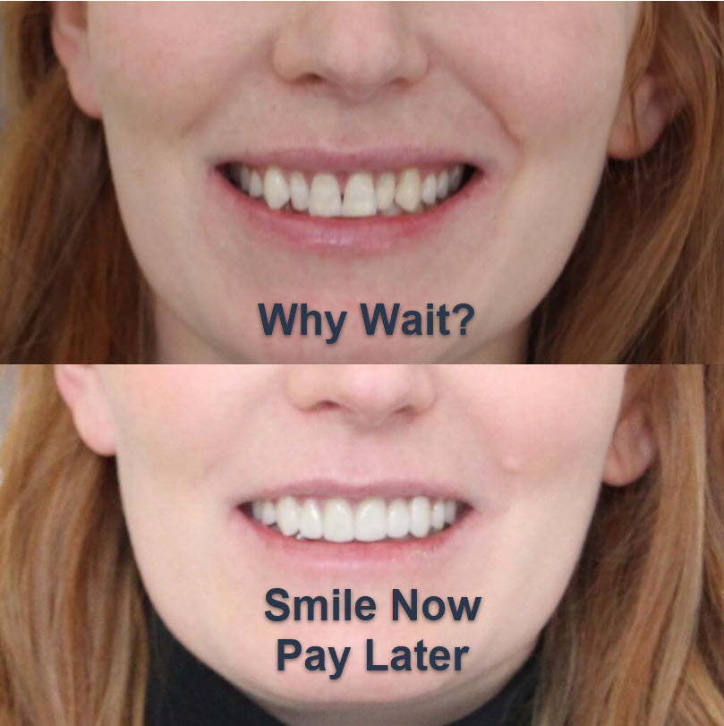 Dental Finance helps you spread the cost of dental work over time but get the work done immediately. At Garners Dental we understand cost can be a delaying factor but why should you live in pain or not get the dental work you need now when we offer dental finace as a better solution.